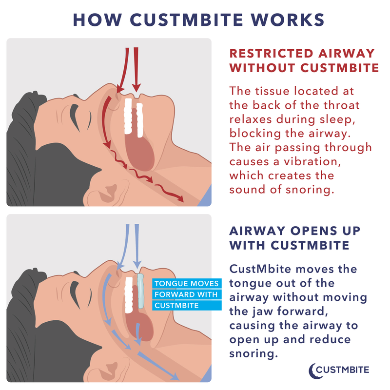 Information graphic of what happens in a restricted airway and how the CustMbite snoring system helps. 